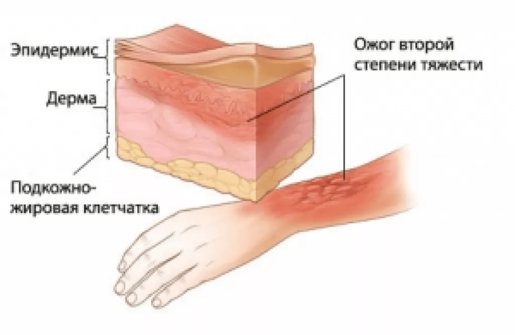 На калужском "Фольксвагене" начальники принуждают рабочих жечь себе руки